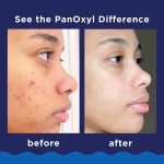 PanOxyl Acne Foaming Wash - Image 5